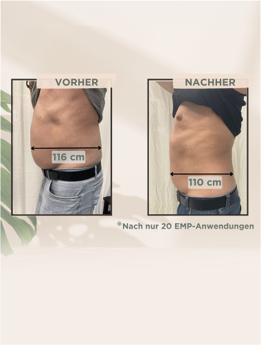 EMPulse Ergebnis: Bauchumfang -6 cm nach 20 Behandlungen